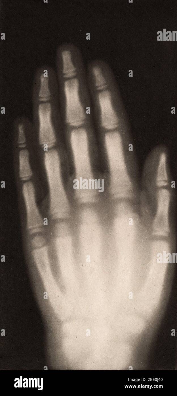 Historical X-ray of the hand of an 8-year-old girl, 1896. Taken by Josef Maria Eder (Austrian, 1855-1944) and Eduard Valenta (Austrian, 1857-1937). Photogravure. Eder was the director of an institute for graphic processes and the author of an early history of photography. With the photochemist Valenta, he produced a portfolio in January 1896, less than a month after Wilhelm Conrad Rontgen published his discovery of X-rays. Eder and Valenta's volume, from which this plate derives, demonstrated the X-ray's magical ability to reveal the hidden structure of living things. Human hands and feet, fis Stock Photo