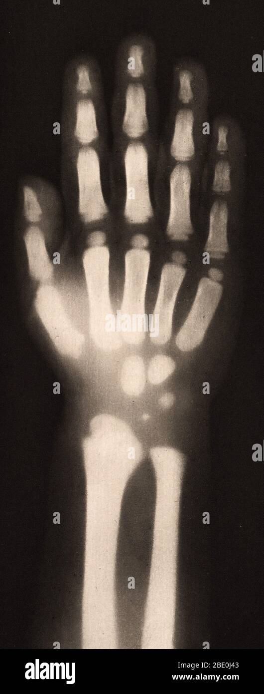 Historical X-ray of the hand of a 4-year-old child, 1896. Taken by Josef Maria Eder (Austrian, 1855-1944) and Eduard Valenta (Austrian, 1857-1937). Photogravure. Eder was the director of an institute for graphic processes and the author of an early history of photography. With the photochemist Valenta, he produced a portfolio in January 1896, less than a month after Wilhelm Conrad Rontgen published his discovery of X-rays. Eder and Valenta's volume, from which this plate derives, demonstrated the X-ray's magical ability to reveal the hidden structure of living things. Human hands and feet, fis Stock Photo