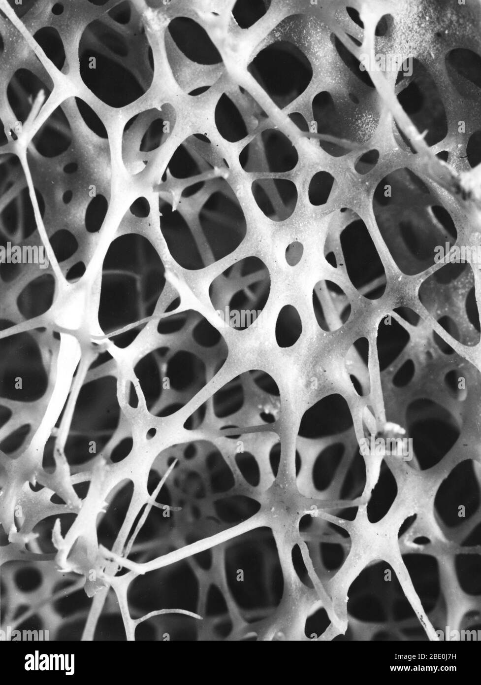 Scanning electron micrograph (SEM) of cancellous (spongy) bone of the human shin. Bone tissue is either compact or cancellous. Compact bone usually makes up the exterior of the bone, while cancellous bone is found in the interior. Cancellous bone is characterised by a honeycomb arrangement of trabeculae. These structures help to provide support and strength. The spaces within this tissue normally contain bone marrow, a blood forming substance. Stock Photo