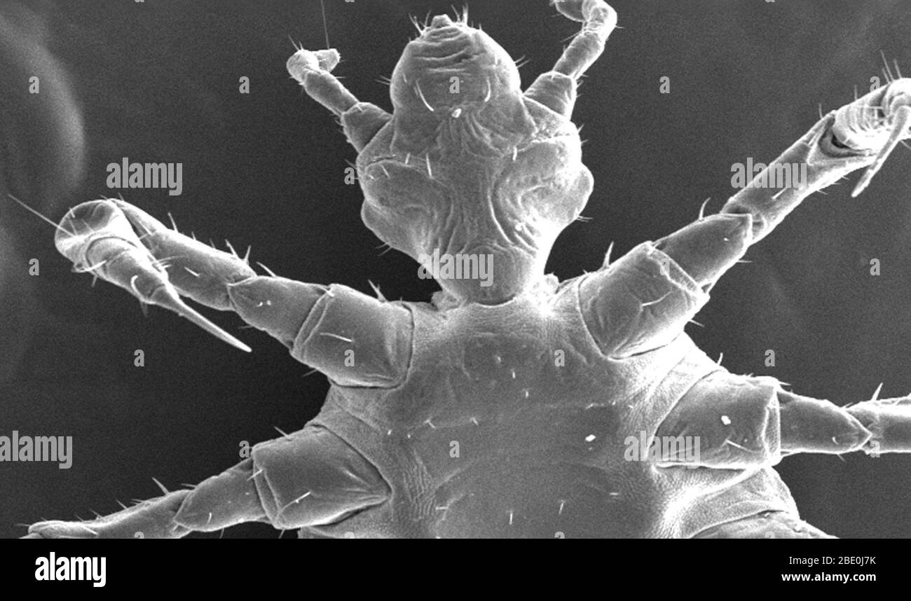 This is one of several scanning electron micrographic (SEM) images successively magnified at higher and higher values, which focuse on the head region of a female body louse, Pediculus humanus var. corporis from a ventral perspective. At a relatively low magnification, this SEM reveals some of the insect's exoskeletal morphology exhibited by its cephalic, or head region, thoracic, and proximal abdominal regions. Of interest is the jointed configuration of its six extremities, from which it derives its classification in the phylum of Athropoda, (i.e., Arthro from 'joint', and poda from 'leg'). Stock Photo