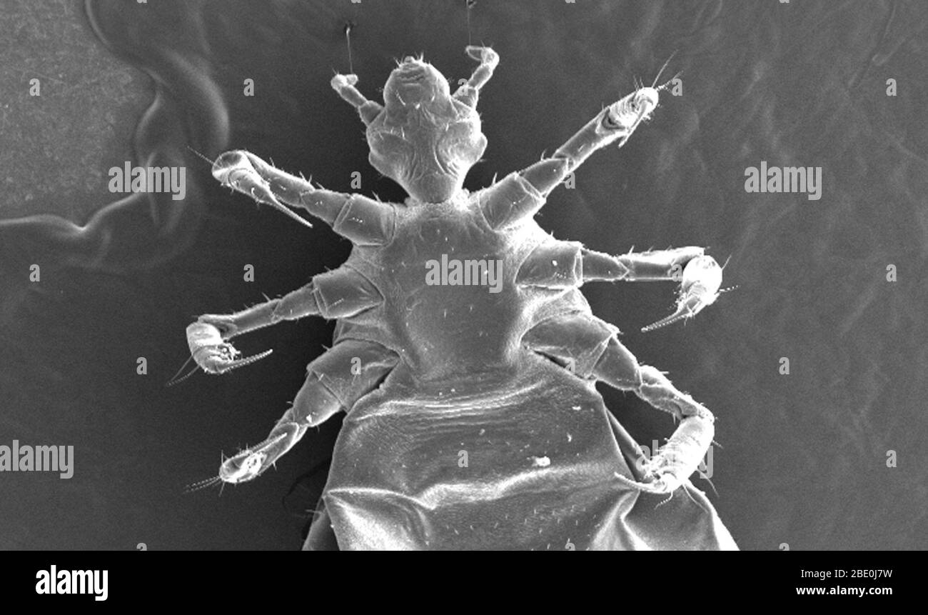 This is one of several scanning electron micrographic (SEM) images successively magnified at higher and higher values, which focuse on the head region of a female body louse, Pediculus humanus var. corporis from a ventral perspective. At a relatively low magnification, this SEM reveals some of the insect's exoskeletal morphology exhibited by its cephalic, or head region, thoracic, and proximal abdominal regions. Of interest is the jointed configuration of its six extremities, from which it derives its classification in the phylum of Athropoda, (i.e., Arthro from 'joint', and poda from 'leg'). Stock Photo