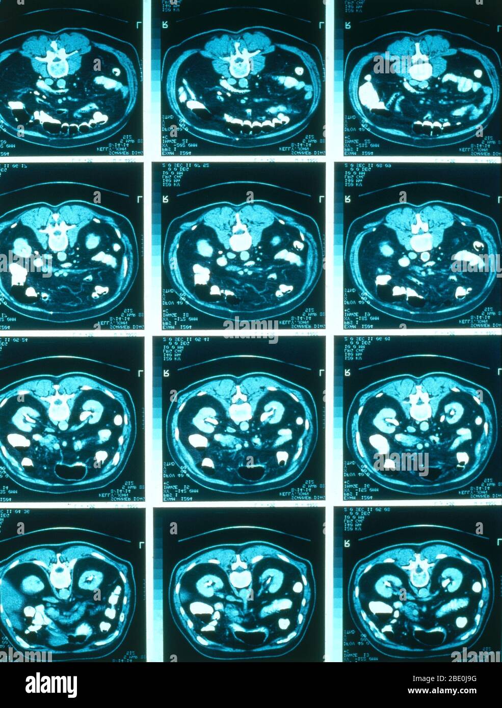Normal CT scans of the abdomen. Stock Photo