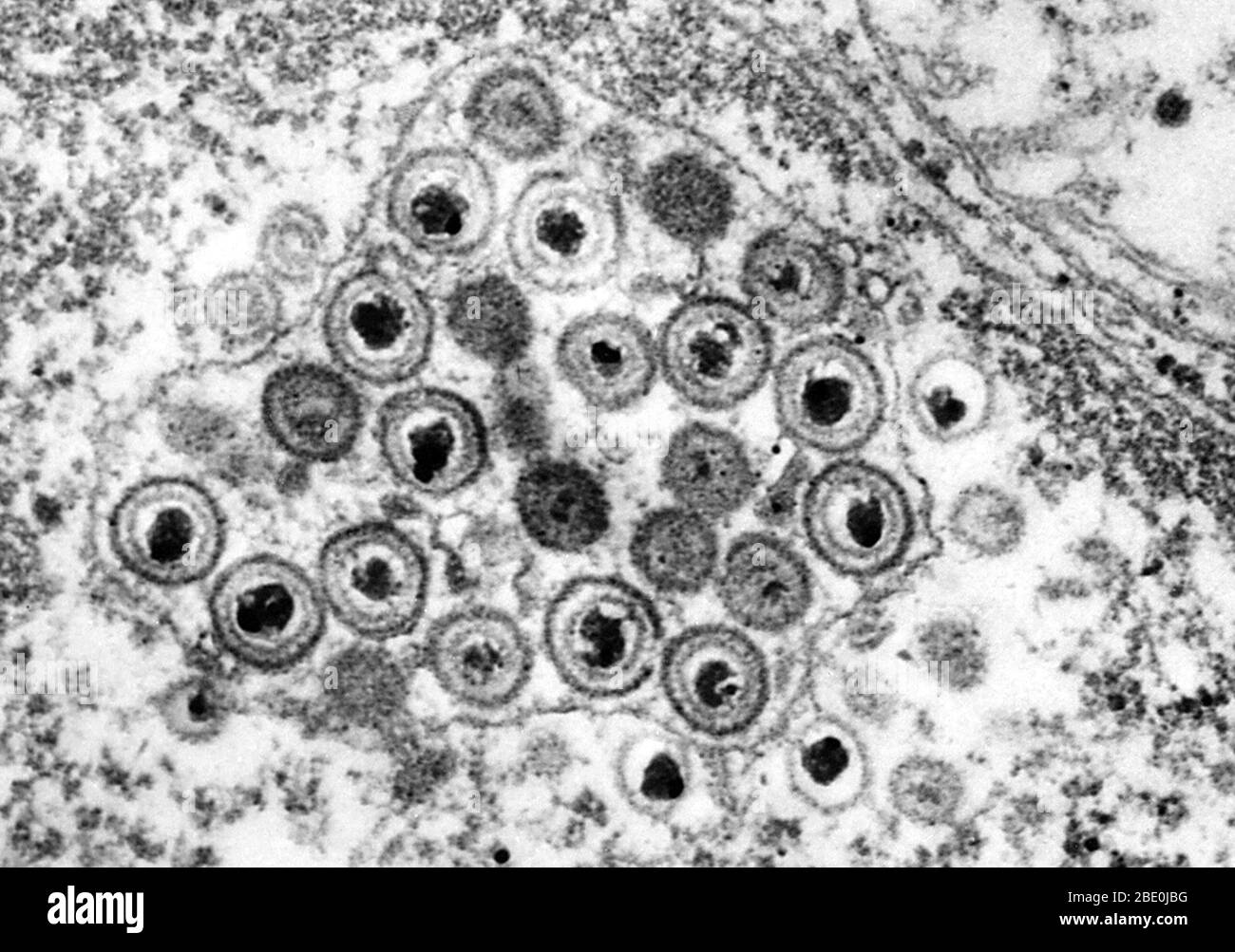 Negative stained Transmission Electron Micrograph (TEM) revealing the presence of numerous herpes simplex virions located inside the nucleus in this tissue sample. Genital herpes is a genital infection caused by the herpes simplex virus (HSV). Most individuals carrying herpes are unaware they have been infected and many will never suffer an outbreak, which involves blisters similar to cold sores. While there is no cure for herpes, over time symptoms are increasingly mild and outbreaks are decreasingly frequent. The typical manifestation of a primary infection is clusters of genital sores consi Stock Photo