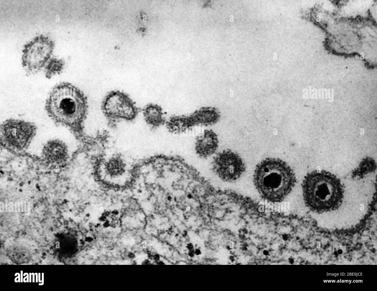 Negative stained Transmission Electron Micrograph (TEM) revealing the presence of numerous herpes simplex virions, located extracellularly in this tissue sample. Genital herpes is a genital infection caused by the herpes simplex virus (HSV). Most individuals carrying herpes are unaware they have been infected and many will never suffer an outbreak, which involves blisters similar to cold sores. While there is no cure for herpes, over time symptoms are increasingly mild and outbreaks are decreasingly frequent. The typical manifestation of a primary infection is clusters of genital sores consist Stock Photo