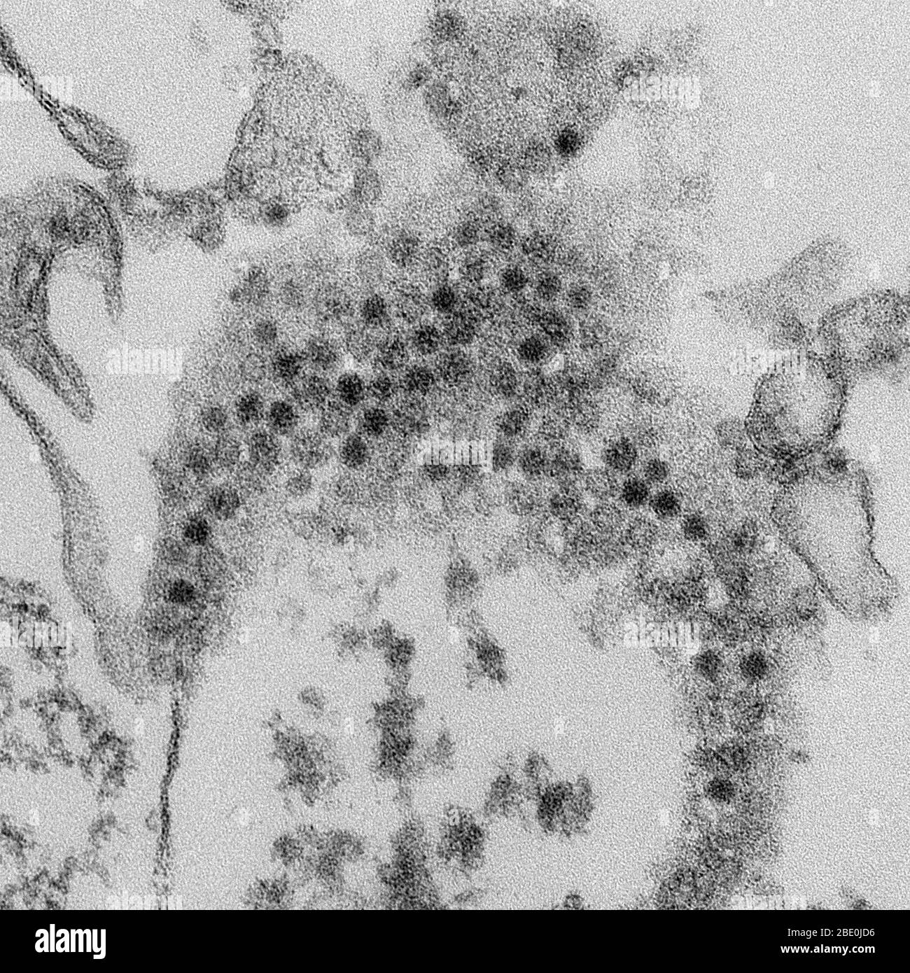 Transmission Electron Micrograph (TEM) reveals numerous, spheroid-shaped Enterovirus 68 (EV68, EV-D68, HEV68) visions which are a member of the Picornaviridae family, an enterovirus. First isolated in California in 1962 and once considered rare, it has been on a worldwide upswing in the 21st century. With some uncertainty, it has been implicated in cases of a polio-like disorder called acute flaccid myelitis. Acute flaccid myelitis (AFM) is a neurologic illness of sudden onset in children. It presents with localized limb weakness of unknown cause. Enterovirus 68, which as a member of the enter Stock Photo