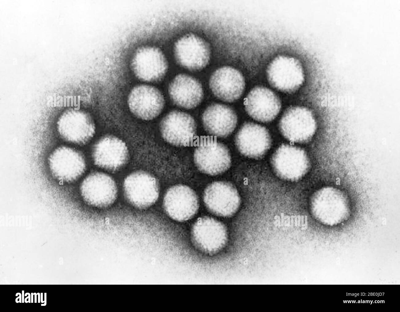 Transmission Electron Micrograph (TEM) of adenovirus particles. Adenoviruses (members of the family Adenoviridae) are nonenveloped viruses with an icosahedral nucleocapsid containing a double stranded DNA genome. Adenovirus infections most commonly cause illness of the respiratory system; however, depending on the infecting serotype, they may also cause various other illnesses and presentations. Apart from respiratory involvement, illnesses and presentations of adenovirus include gastroenteritis, conjunctivitis, cystitis, and rash illness. Symptoms of respiratory illness caused by adenovirus i Stock Photo