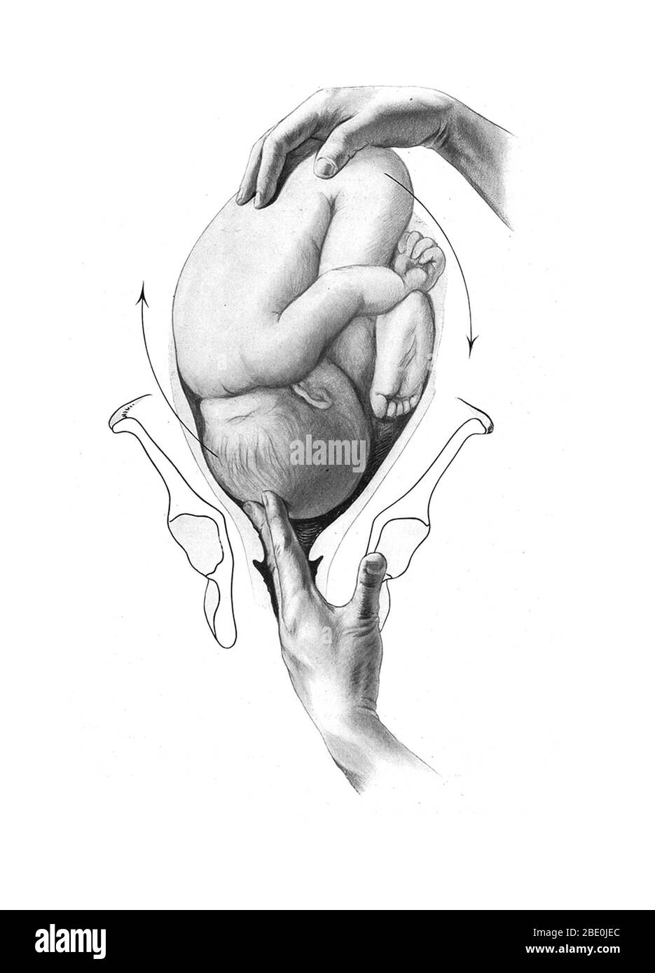 The position of the child is important for normal birthing procedure: head-first birth is preferred. Birth trauma (BT) refers to damage of the tissues and organs of a newly delivered child, often as a result of physical pressure or trauma during childbirth. The term also encompasses the long term consequences, often of a cognitive nature, of damage to the brain or cranium. Medical study of birth trauma dates to the 16th century, and the morphological consequences of mishandled delivery are described in Renaissance-era medical literature. Illustration from Grundriss zum Studium der Geburtshülfe Stock Photo