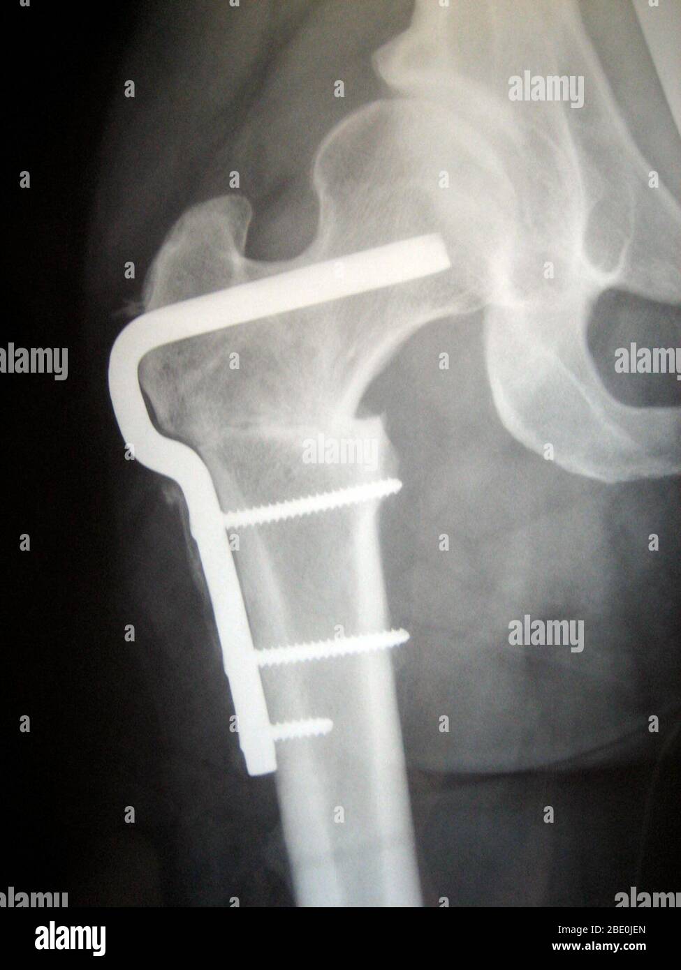 X-ray of femoral osteotomy hardware to correct femoral rotation caused by hip dysplasia. This x-ray shows the right hip in a female patient in her early thirties. Stock Photo