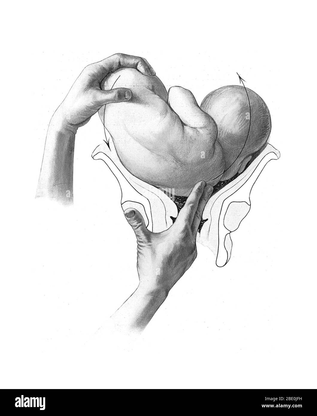 The position of the child is important for normal birthing procedure: head-first birth is preferred. Birth trauma (BT) refers to damage of the tissues and organs of a newly delivered child, often as a result of physical pressure or trauma during childbirth. The term also encompasses the long term consequences, often of a cognitive nature, of damage to the brain or cranium. Medical study of birth trauma dates to the 16th century, and the morphological consequences of mishandled delivery are described in Renaissance-era medical literature. Illustration from Grundriss zum Studium der Geburtshülfe Stock Photo