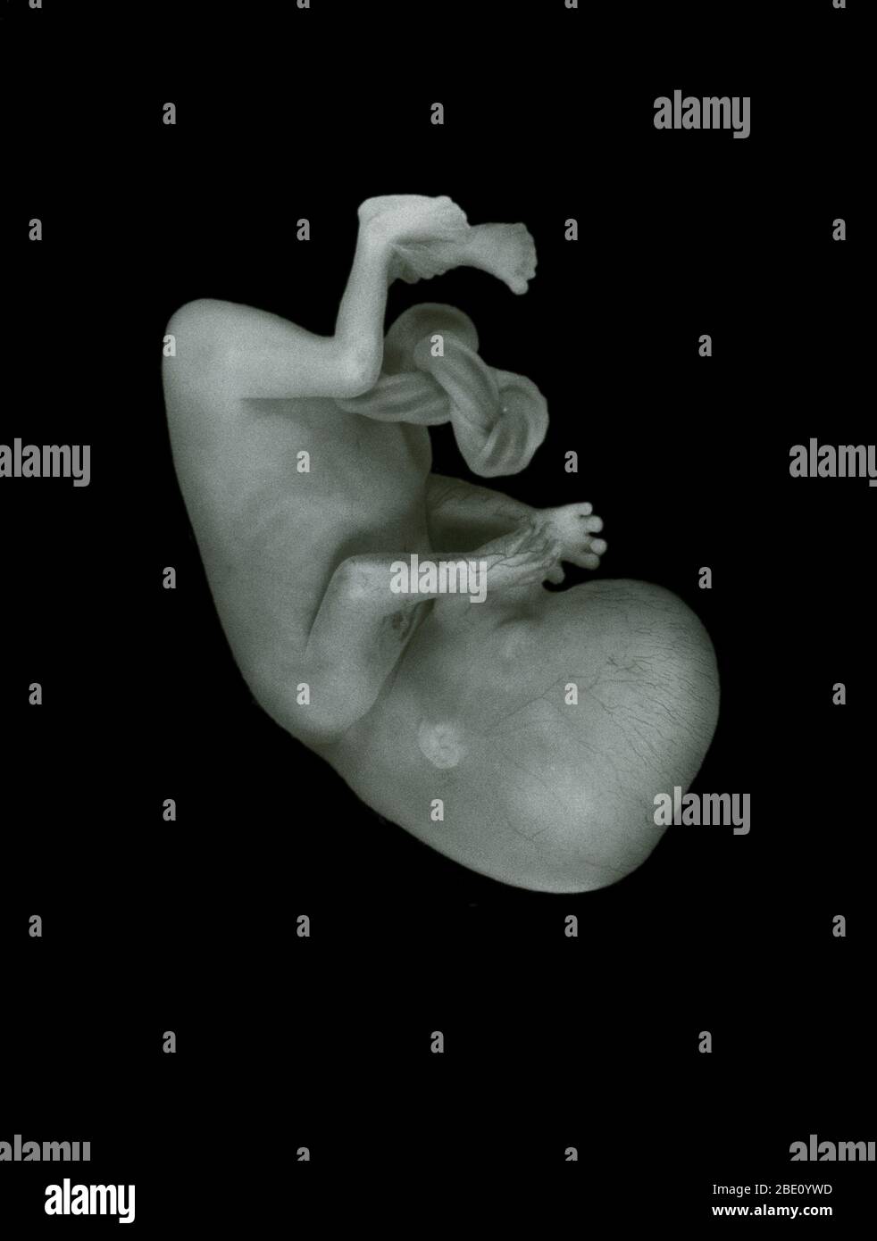 13 week old human fetus. During the thirteenth week, the intestines start migrating from the umbilical cord into the abdomen, the villi in the intestines are forming, and meconium (first stool) is developing. Stock Photo