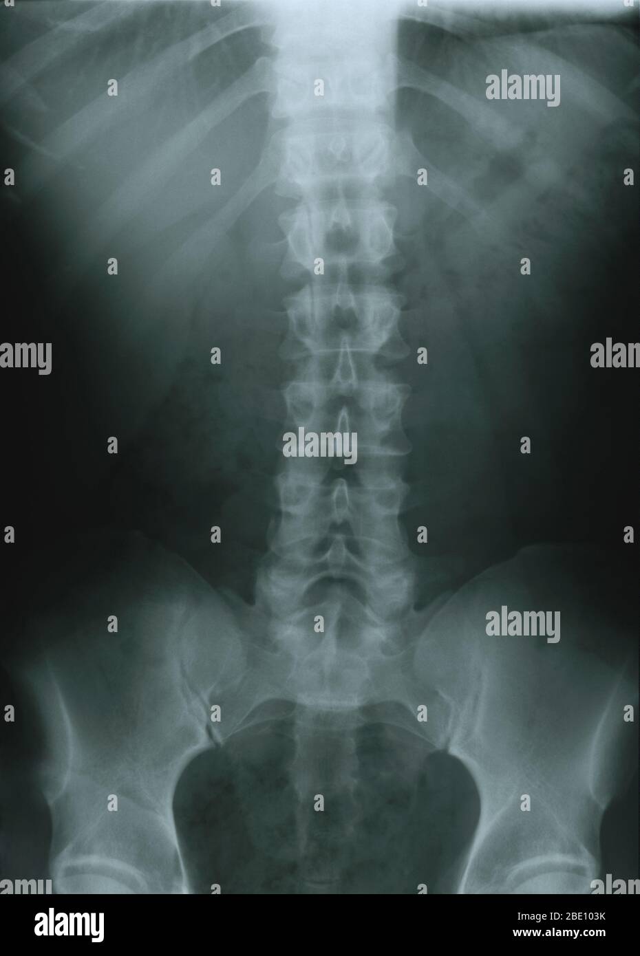 X-ray of lumbar spine of male, age 36. Noticeable is compression of the vertebrae leading to disc herniation. The collagenous disks that are interposed between the vertebrae of the spine act as shock absorbers and most of the body load is transmitted through them. If a disk ruptures (prolapses), it may come to press on a nerve, causing localized pain. A common misconception is that disks can 'slip', when in fact they burst and their gelatinous content is forced through the tough outer sheath that would normally contain it. When the rupture occurs lower down the spine the pain seems to come fro Stock Photo