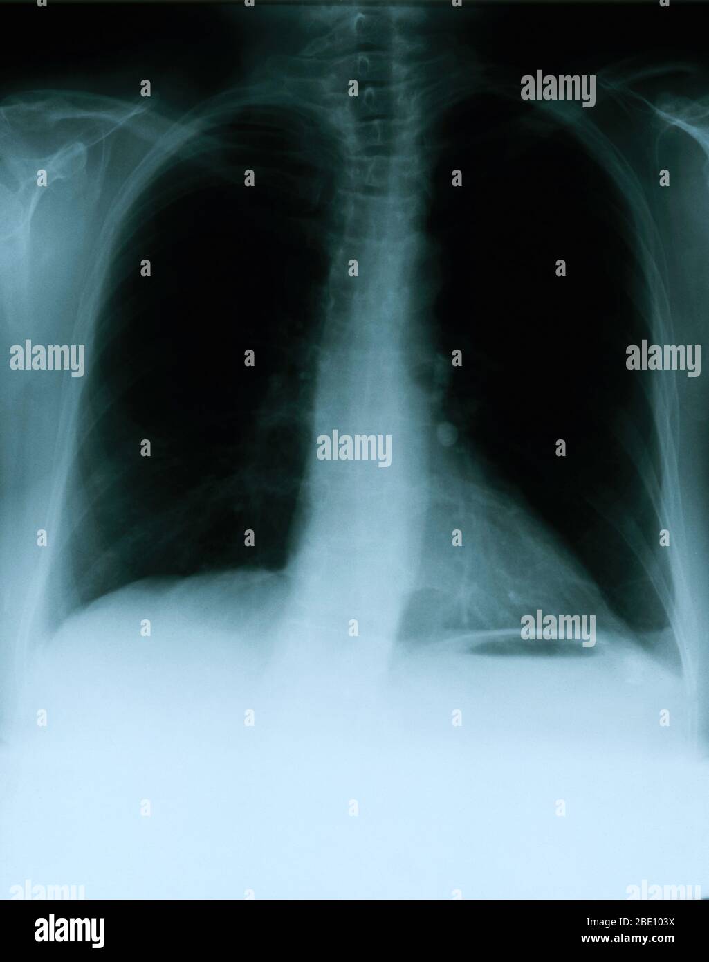 X-ray showing a frontal view of the chest of a 54 year old female. The x-ray shows a calcified left hilar lymph node which most likely resulted from prior granulomatous disease. Also noticeable is a vague area of increased density within the lateral aspect of the right apex, and a mild scoliotic deformity of the dorsal spine. Stock Photo