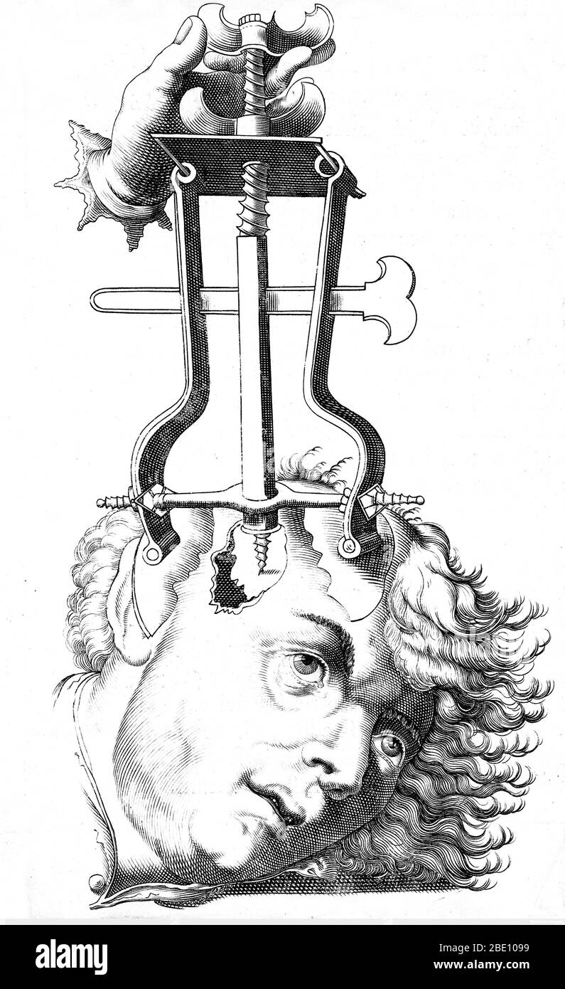 Removing the bone with a trochlea bipes, after trephination, 16th century. Succenturiatus anatomicus. Petrus Paaw. Published: 1616, based on image from the 1500s. Trepanning is a surgical intervention in which a hole is drilled or scraped into the human skull, exposing the dura mater to treat health problems related to intracranial diseases. Cave paintings indicate that people believed the practice would cure epileptic seizures, migraines, mental disorders and the bone that was trepanned was kept as a charm to keep evil spirits away. Trepanation was also practiced in the classical and Renaissa Stock Photo