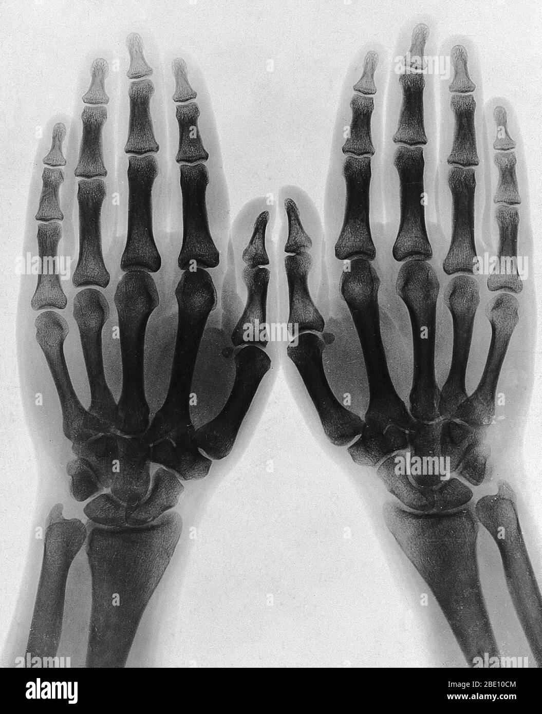 Two hands, viewed by x-ray. Photoprint from radiograph, after Sir Arthur Schuster, 1896. German physicist Wilhelm Rontgen is usually credited as the discoverer of x-rays in 1895, because he was the first to systematically study them, though he is not the first to have observed their effects. He is also the one who gave them the name 'x-rays' (signifying an unknown quantity) though many others referred to these as 'Rontgen rays' (and the associated x-ray radiograms as, 'Rontgenograms' for several decades after their discovery. Stock Photo