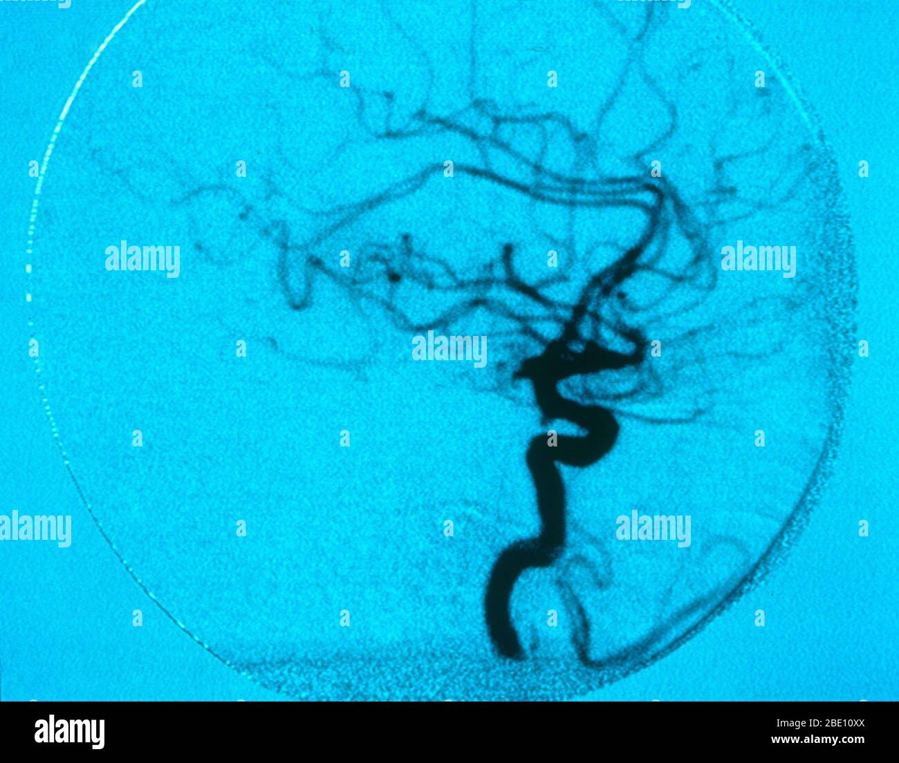 Angiogram of cerebral blood vessels. Stock Photo