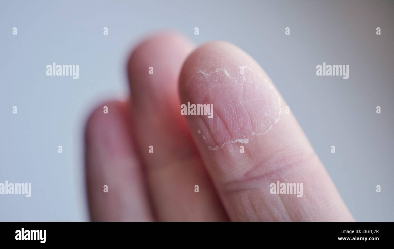 Dry skin on a hand, close up Stock Photo