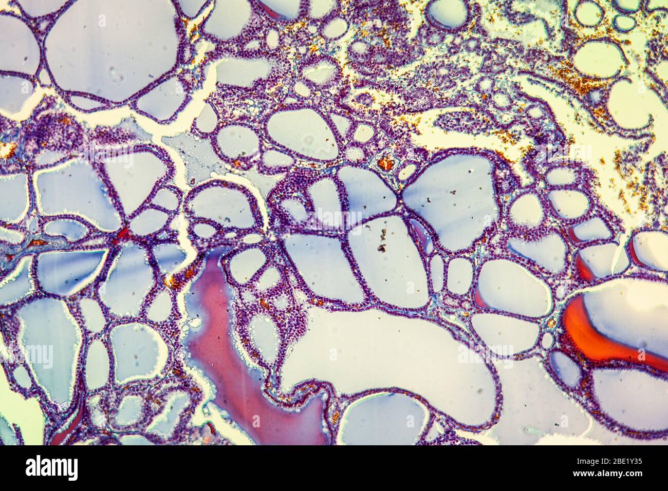 Goiter with colloid thyroid disease 100x Stock Photo Alamy