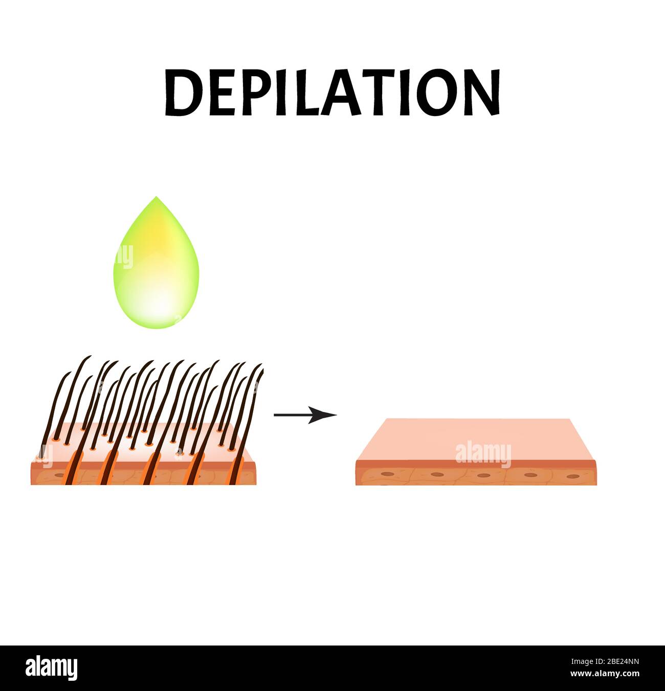 Hair depilation. Hair removal. Infographics. Vector illustration on