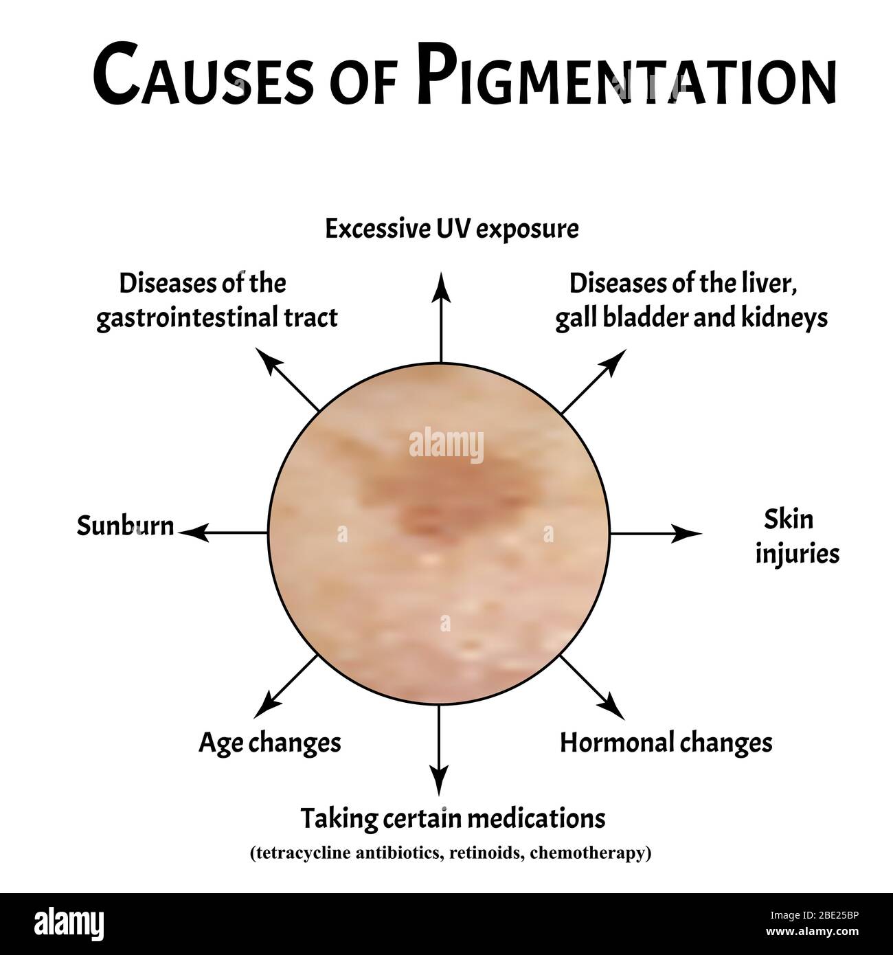 skin pigmentation brown patches