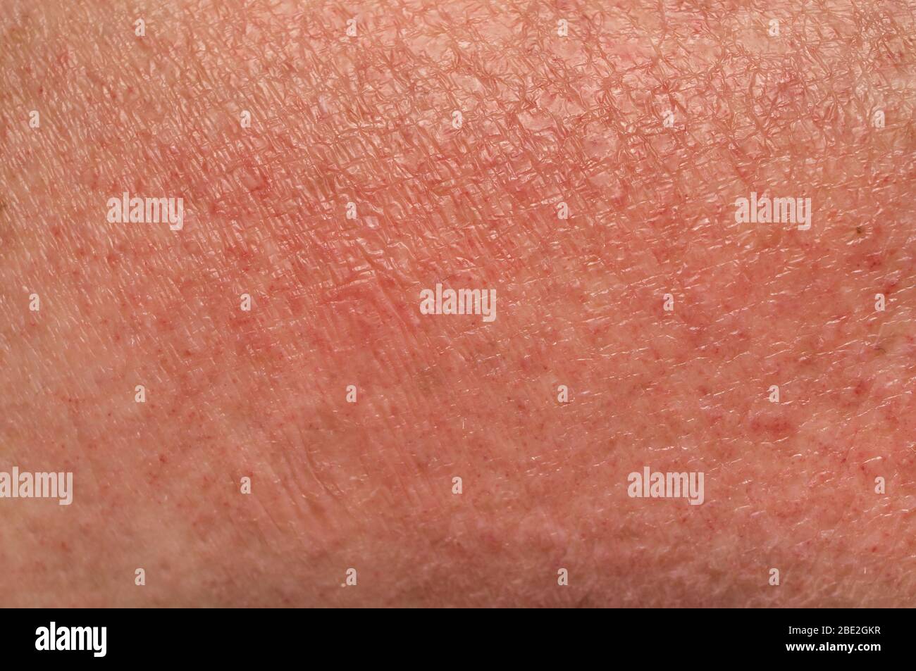 Skin Manifestations Of An Allergic Reaction To The Sun Close Up Soft