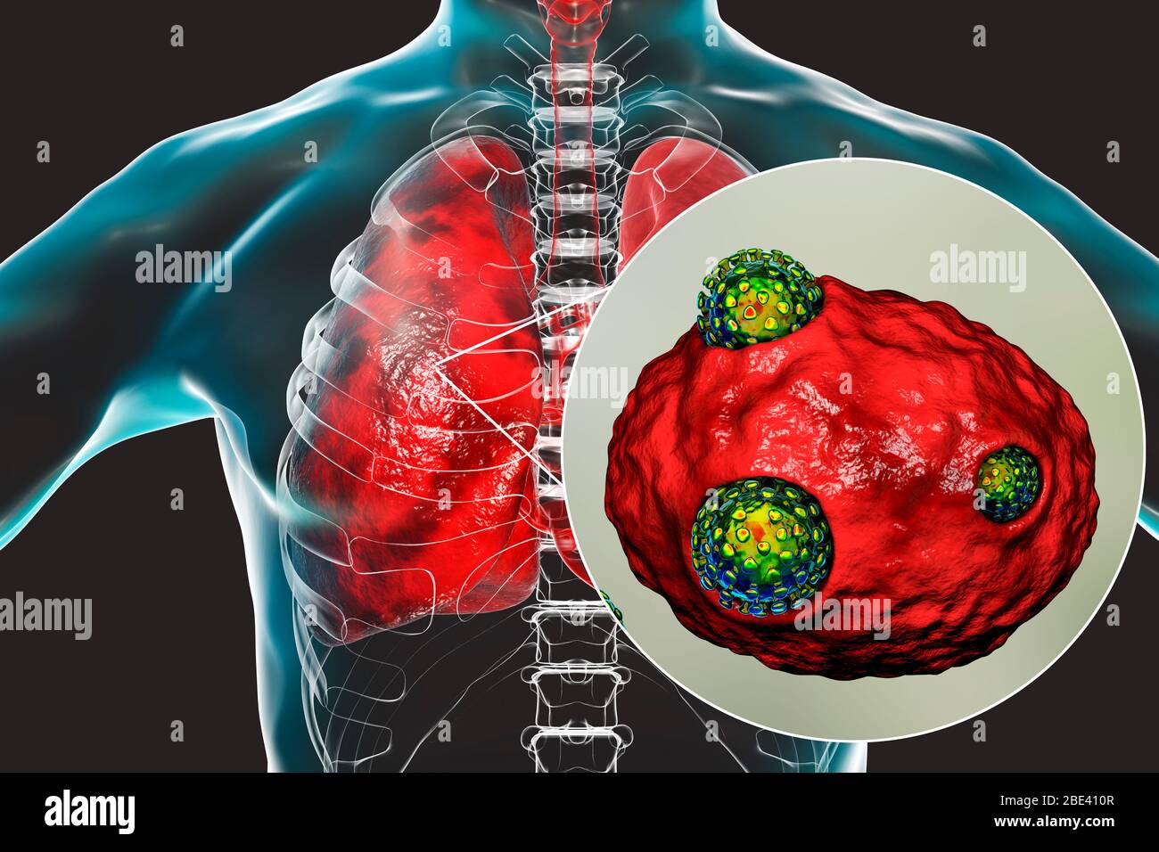 Coronavirus pneumonia. Conceptual computer illustration showing ...