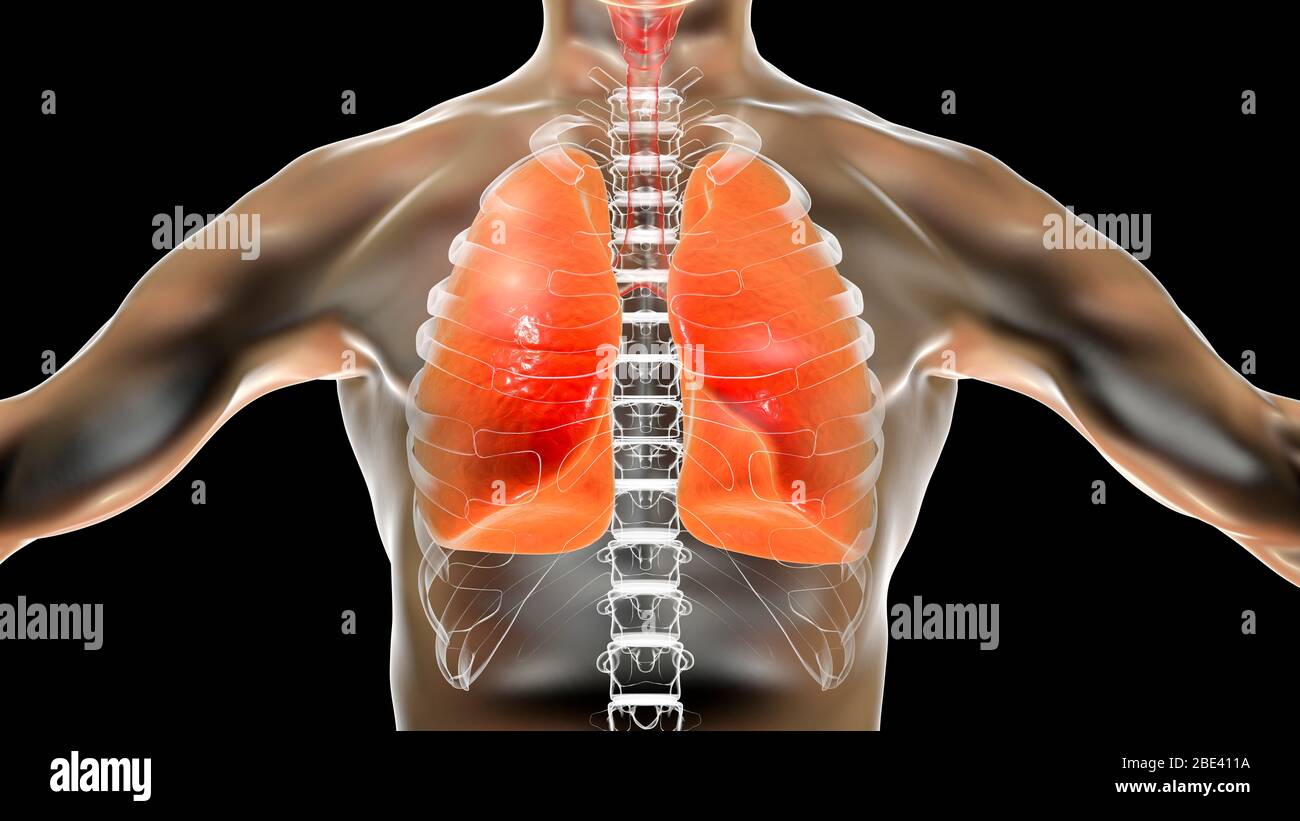 Pneumonia, illustration. Pneumonia is an inflammatory condition of the lung. Stock Photo