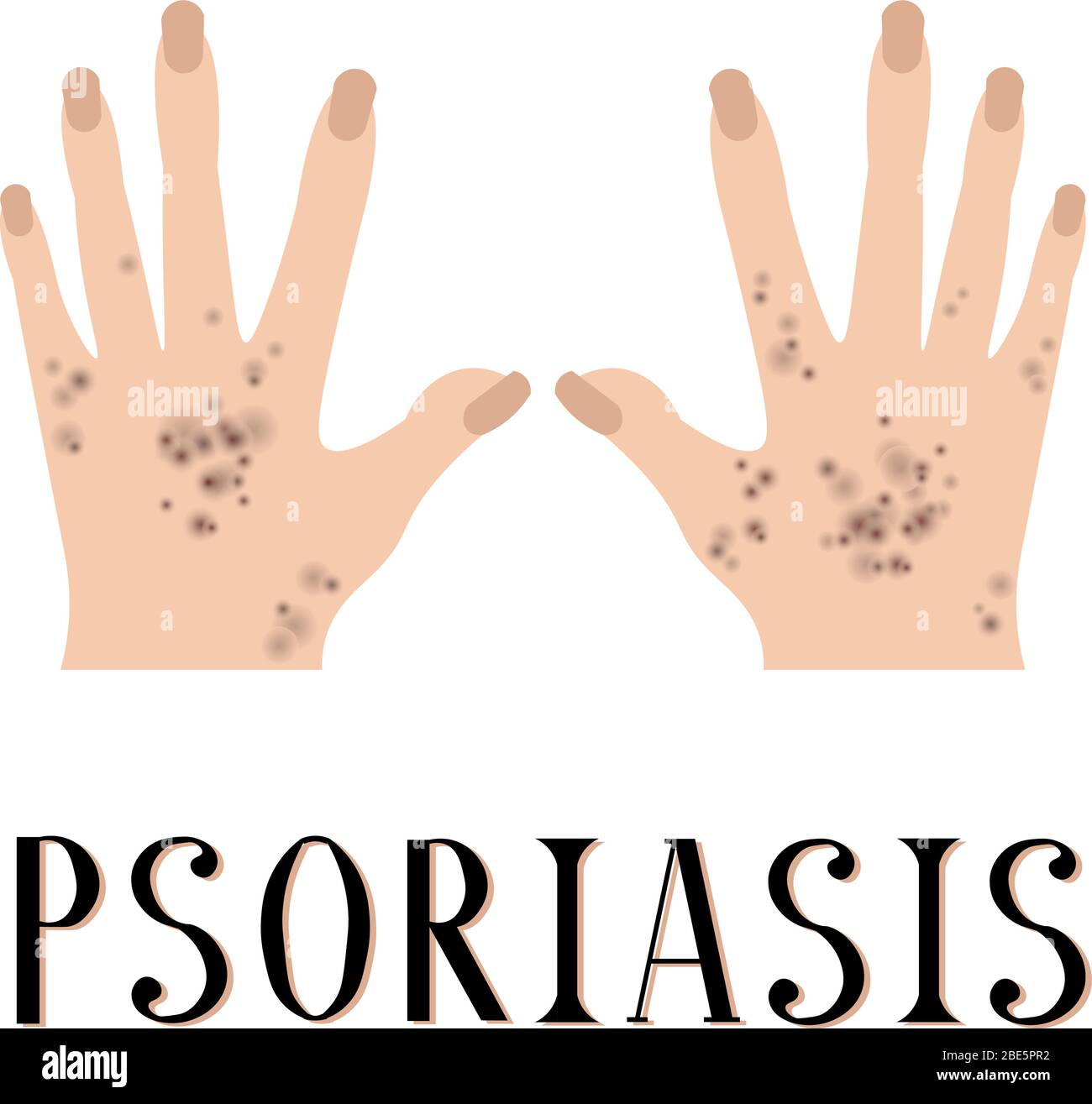 Eczema vector vectors hires stock photography and images Alamy