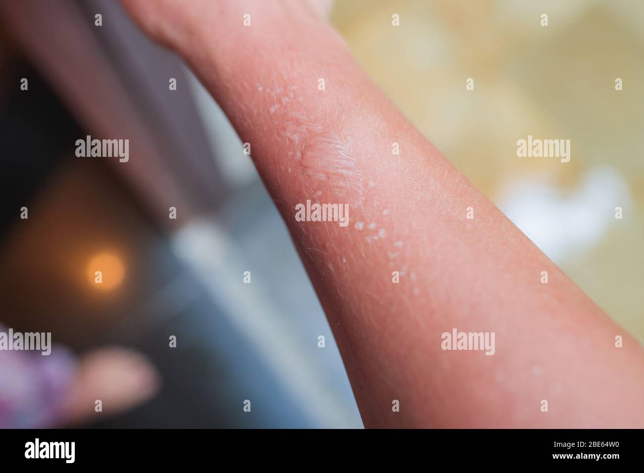 Image of burn or blister in wrist. Left hand. Hand of a woman. Image