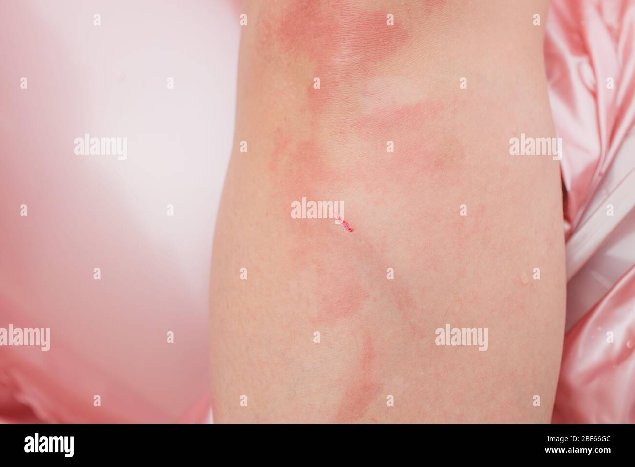 Dermatitis Herpetiformis skin rash in a woman with Nonceliac Gluten Sensitivity. Serum antibodies positive to wheat and gluten. Colonoscopy and upper Stock Photo