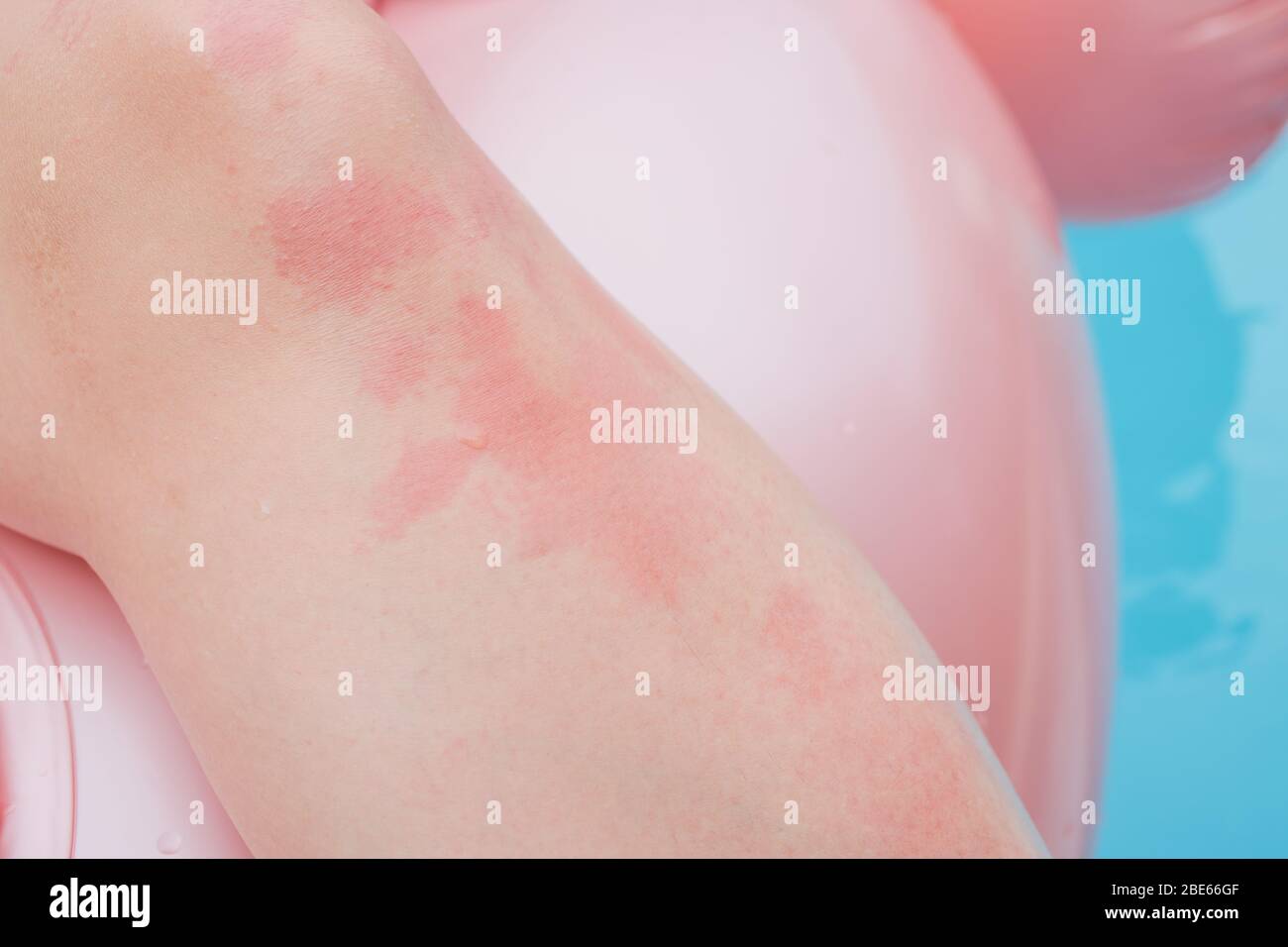 Dermatitis Herpetiformis skin rash in a woman with Nonceliac Gluten Sensitivity. Serum antibodies positive to wheat and gluten. Colonoscopy and upper Stock Photo