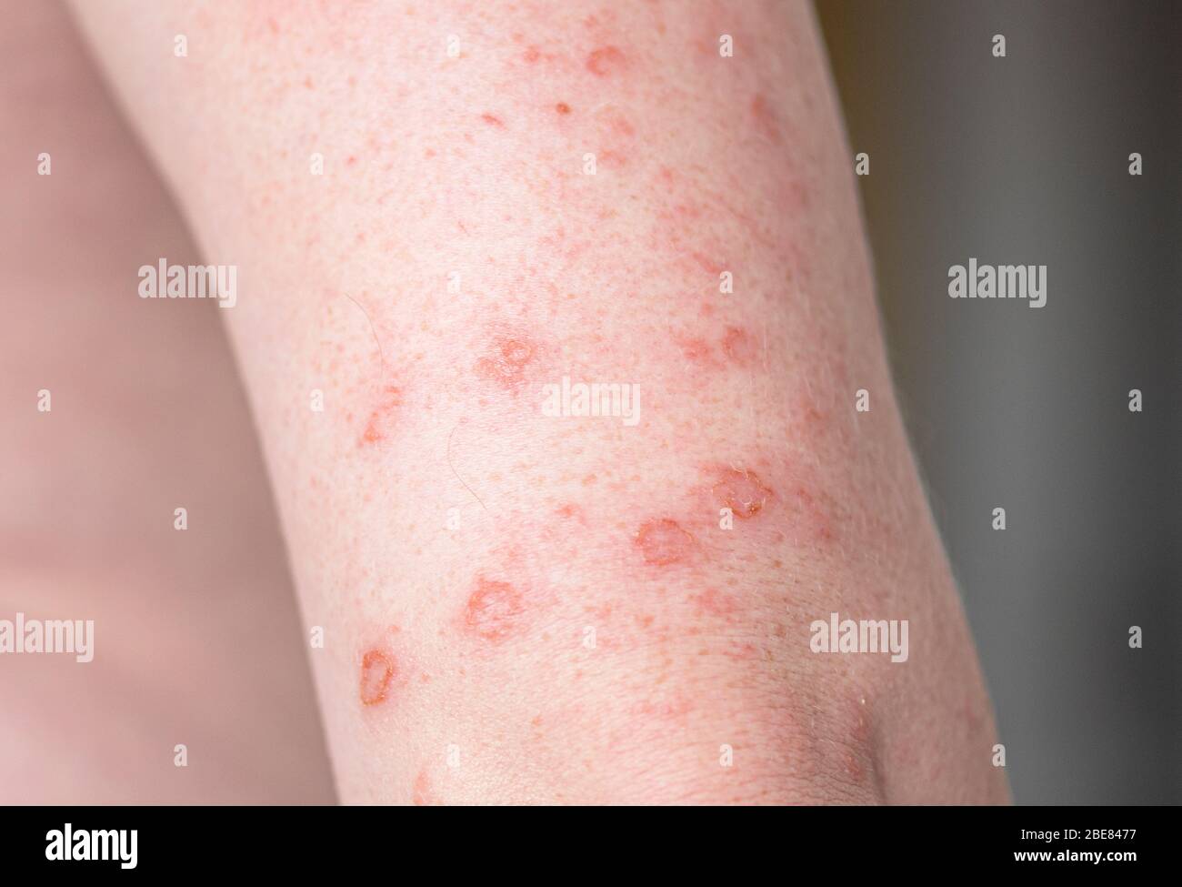 Close-up body with allergic rash, eczema on hands, skin with red bumps and blisters Stock Photo