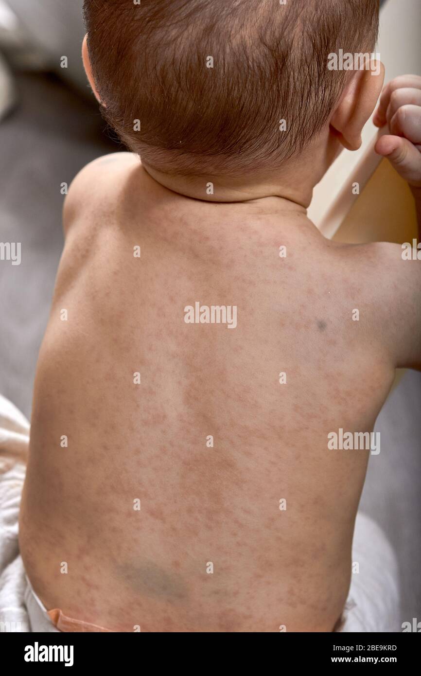 roseola rash a viral rash on the skin of a child Stock Photo Alamy
