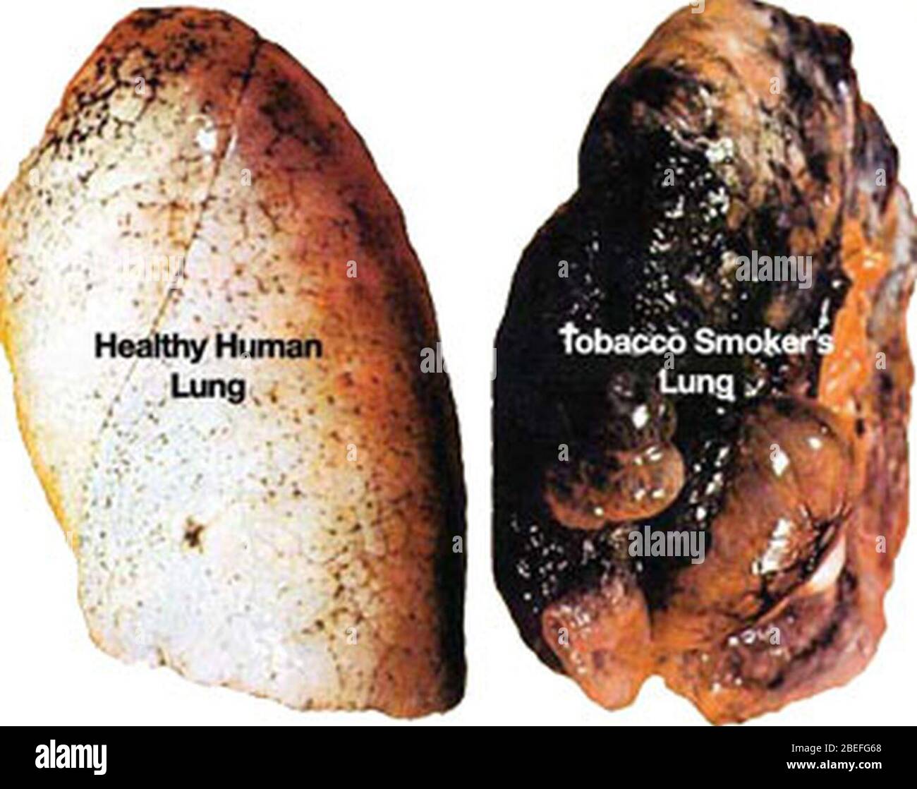 Healthy lung-smokers lung. Stock Photo