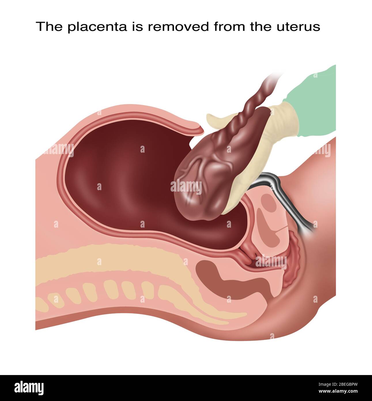 Cesarean Section Steps, Illustration, 3 of 4 Stock Photo