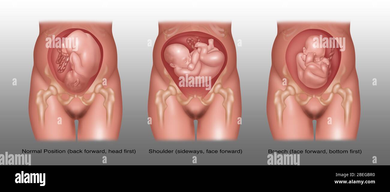 Breech Baby High Resolution Stock Photography And Images Alamy