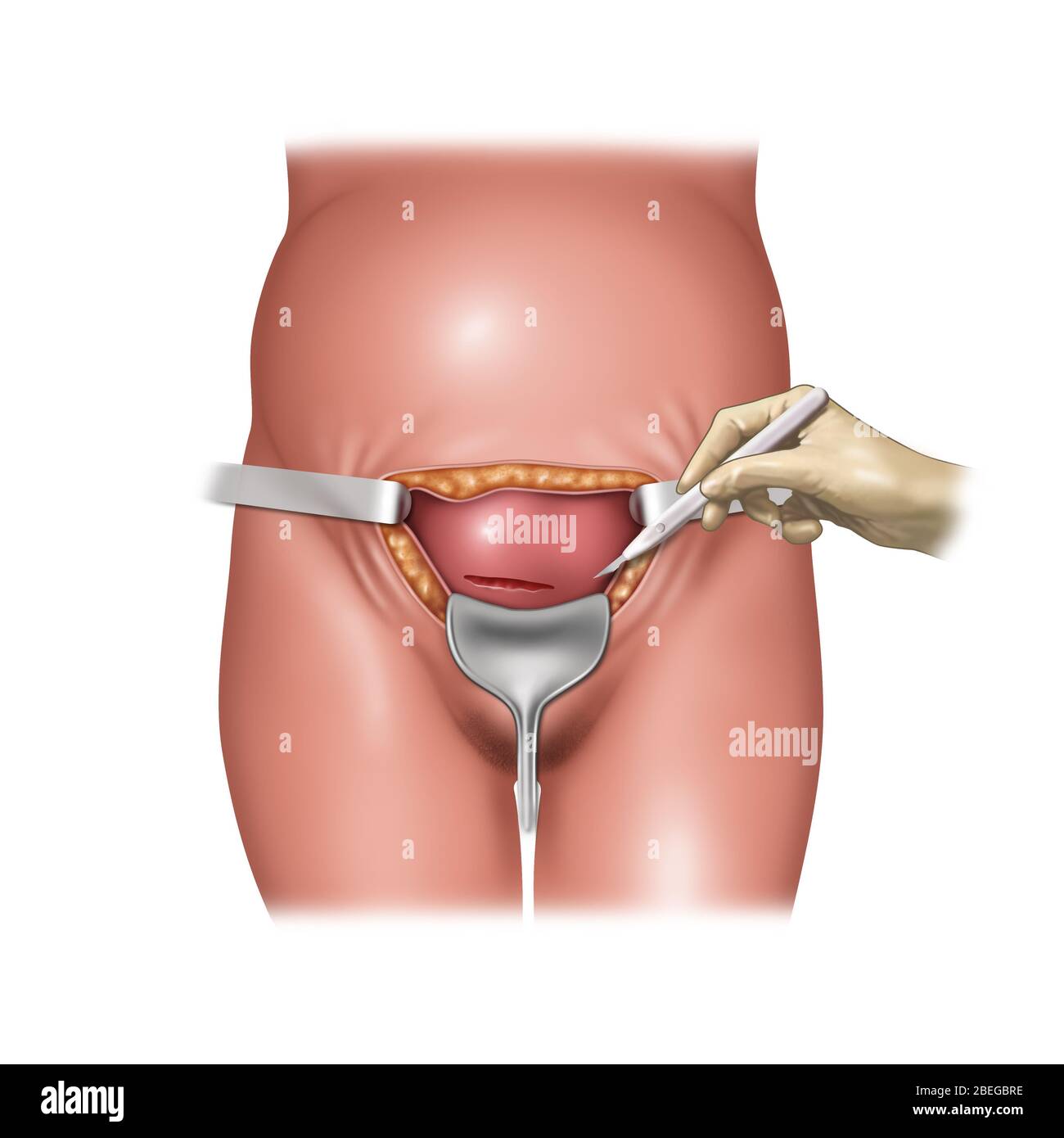 cesarean-section-incisions-illustration-stock-photo-alamy