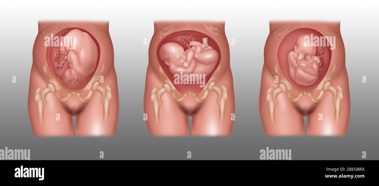 Fetus Positions in Uterus, Illustration Stock Photo