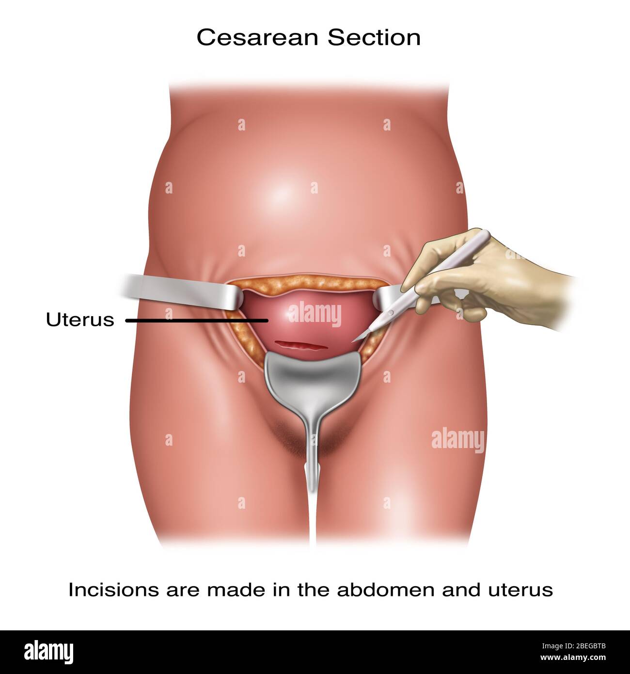 Cesarean section birth hi-res stock photography and images - Alamy