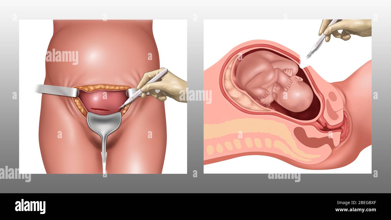 Cesarean section hi-res stock photography and images - Alamy