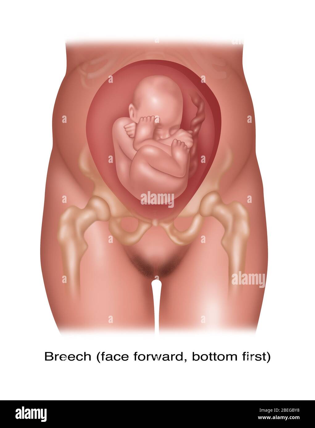 Fetus in Breech Position, Illustration Stock Photo