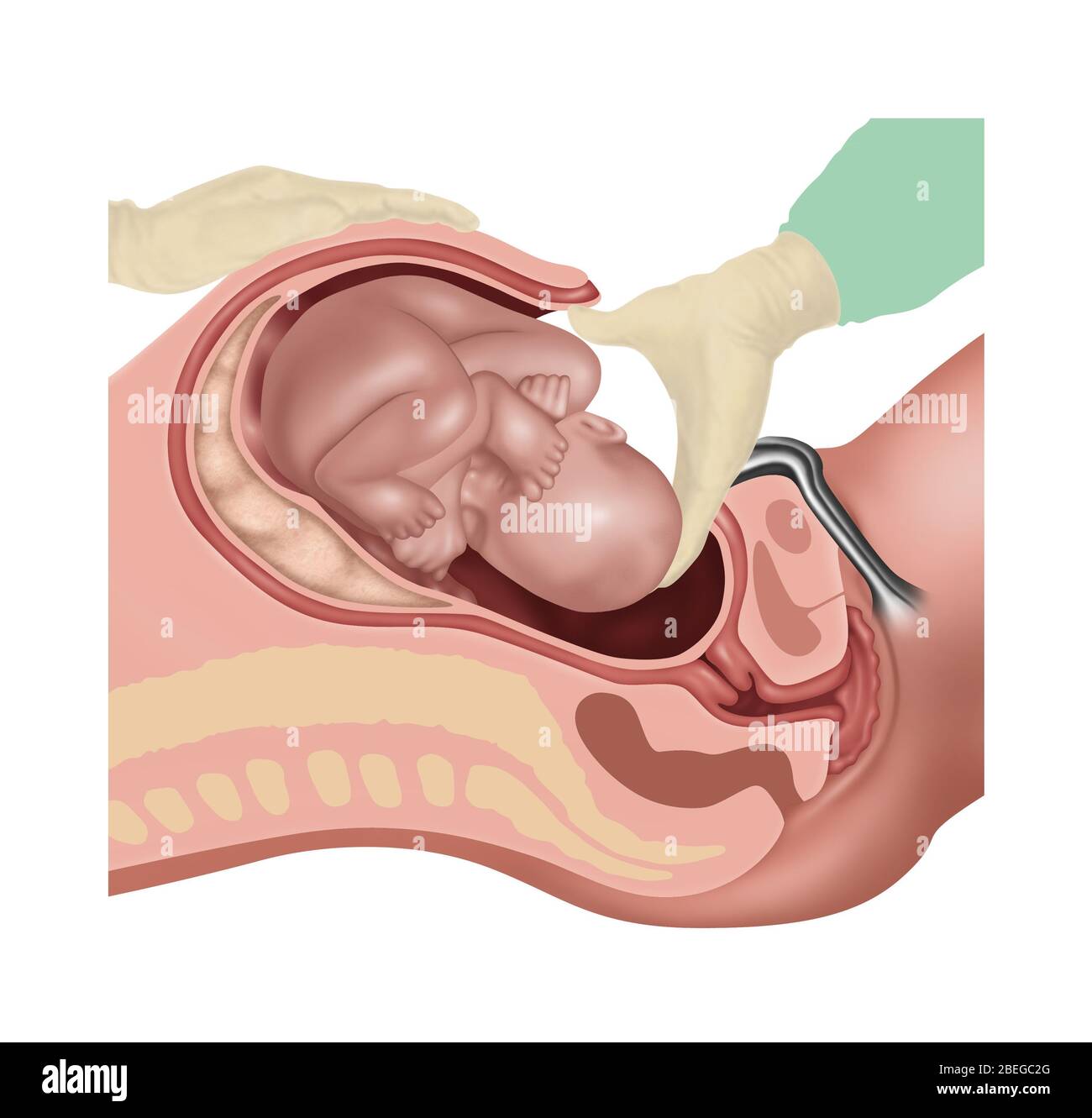 Cesarean Section Steps, Illustration, 2 of 4 Stock Photo