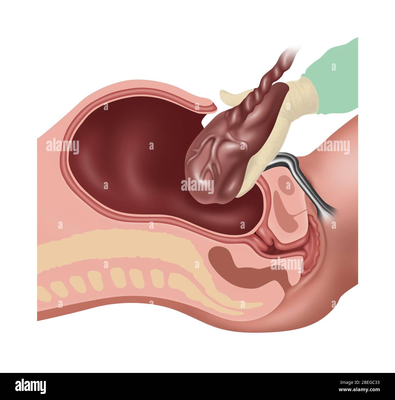 Cesarean Section Steps, Illustration, 3 of 4 Stock Photo