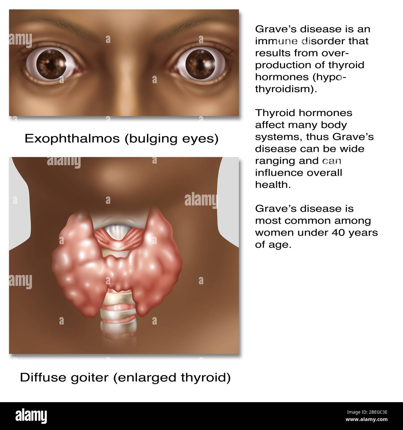 Graves disease hi-res stock photography and images - Alamy