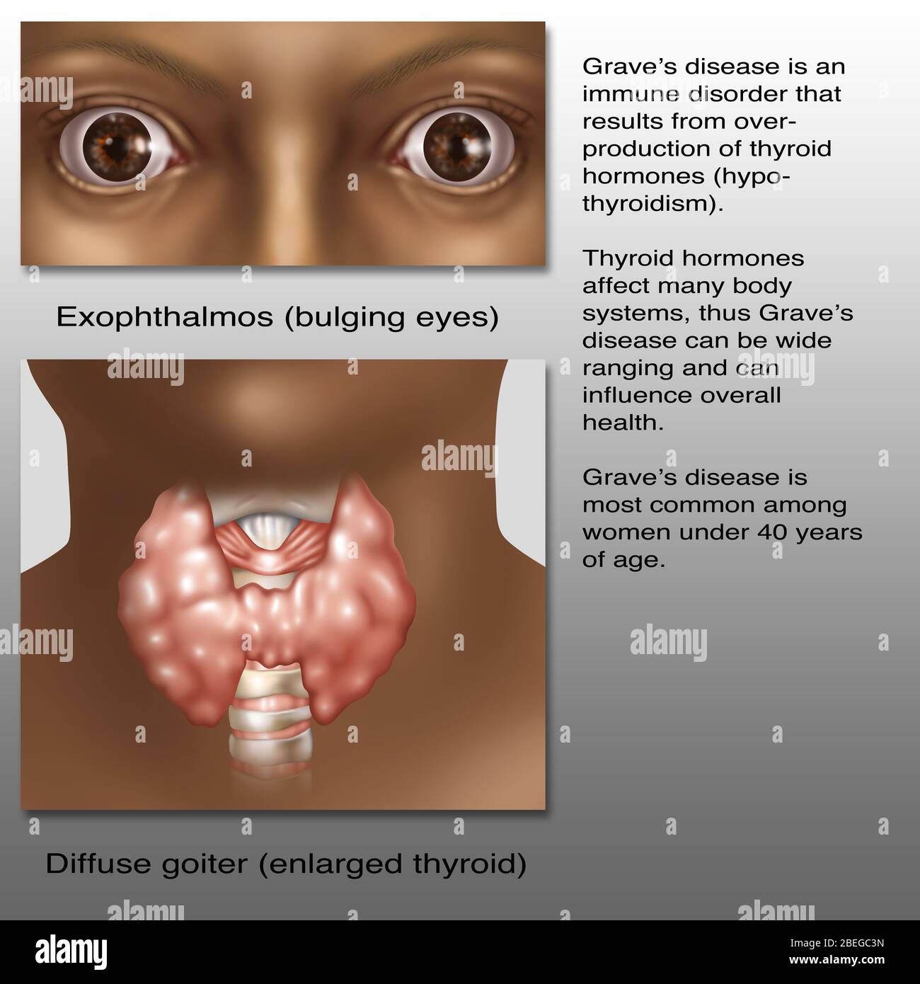 Graves Disease, Illustration Stock Photo Alamy