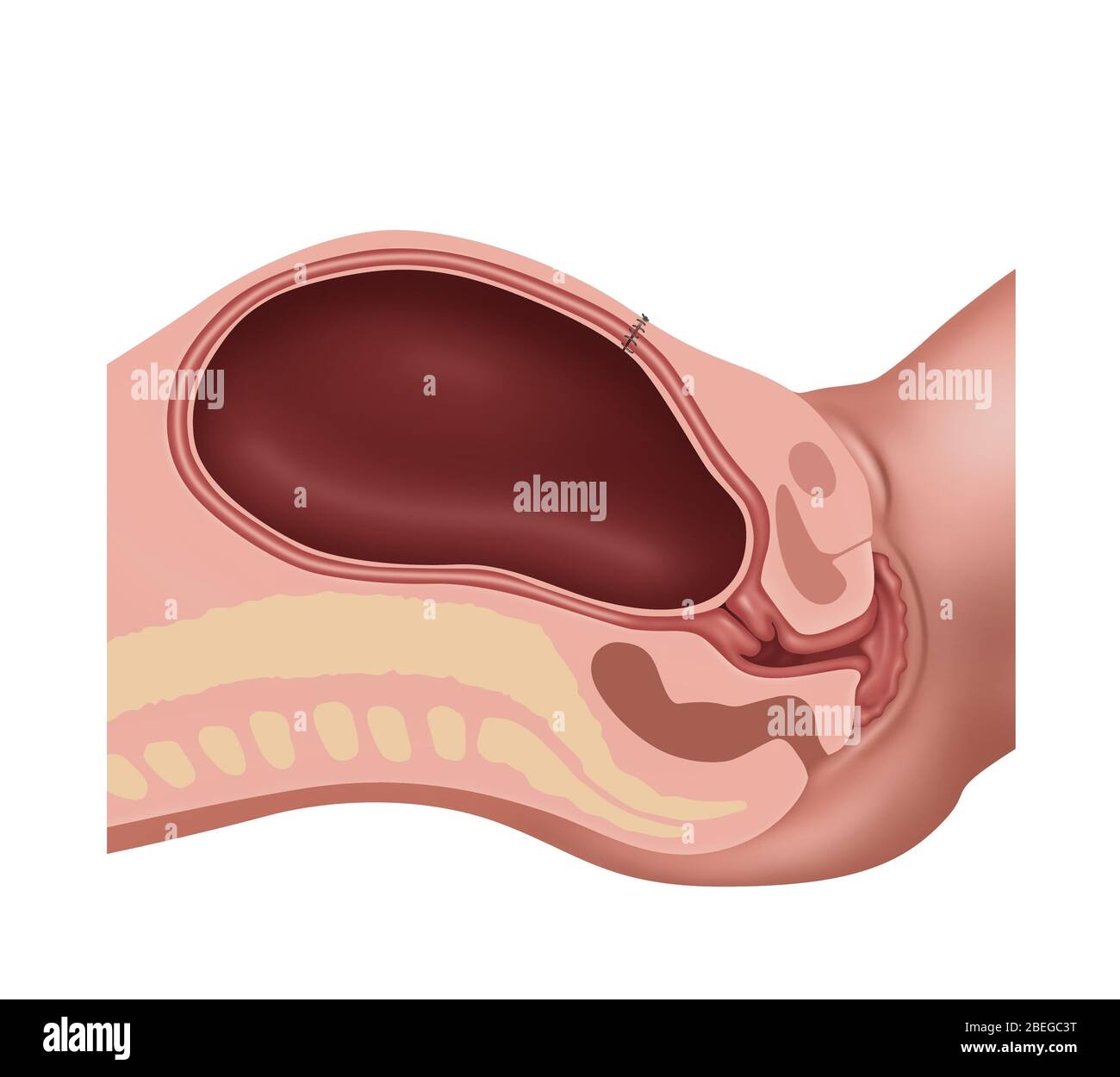 Cesarean Section Steps, Illustration, 4 of 4 Stock Photo