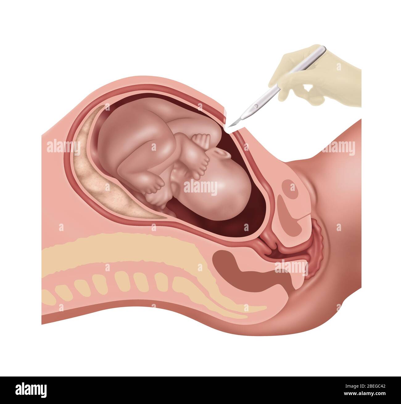 Cesarean Section Steps, Illustration, 1 of 4 Stock Photo