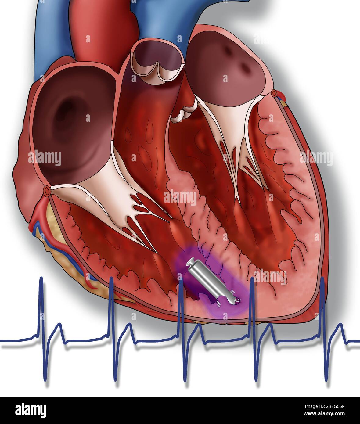 Leadless Pacemaker, Illustration Stock Photo