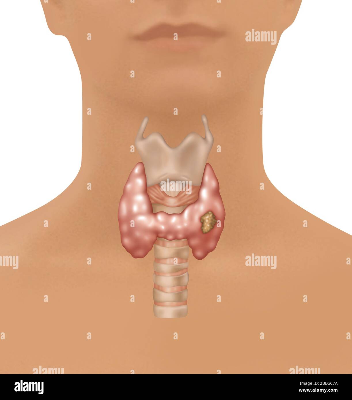 Illustration showing the location of the larynx, thyroid gland, and trachea in a female figure. A malignant growth can be seen in the lower right area of the thyroid. Stock Photo