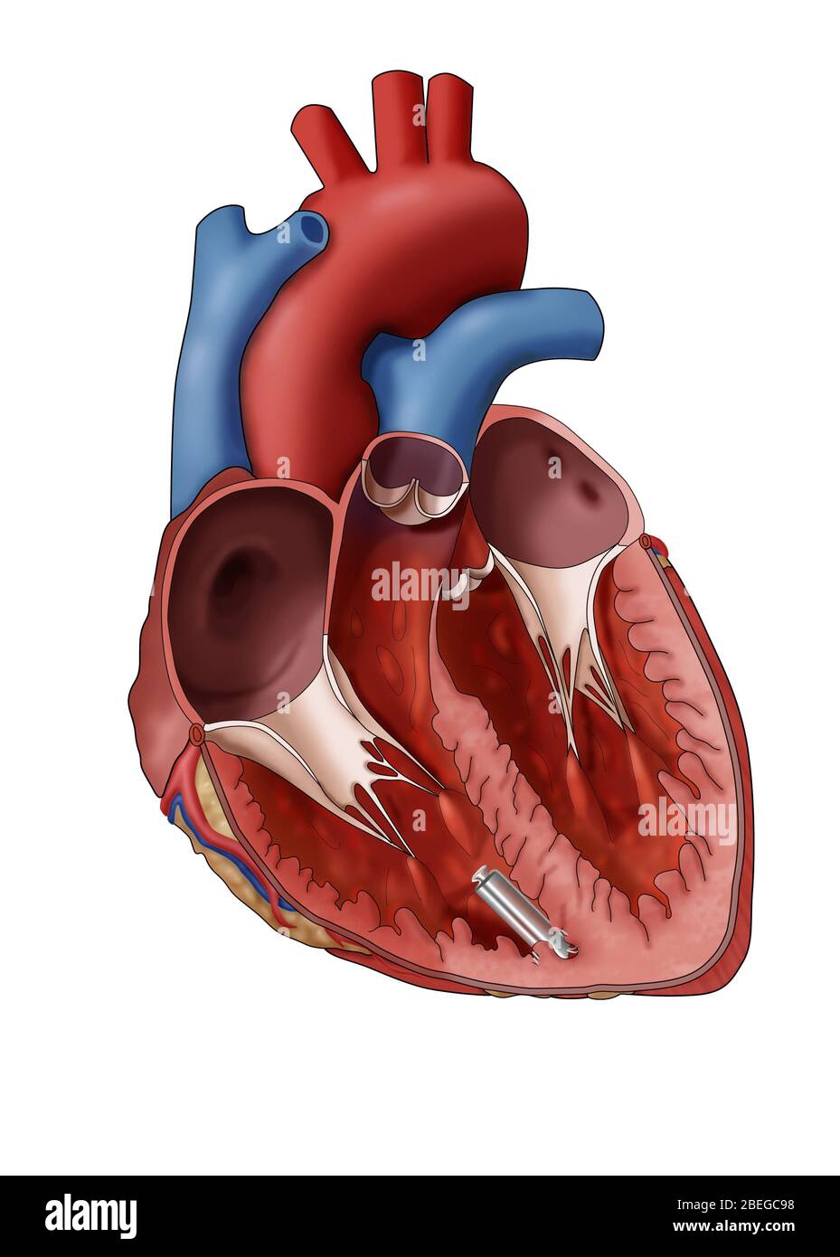 Leadless Pacemaker, Illustration Stock Photo