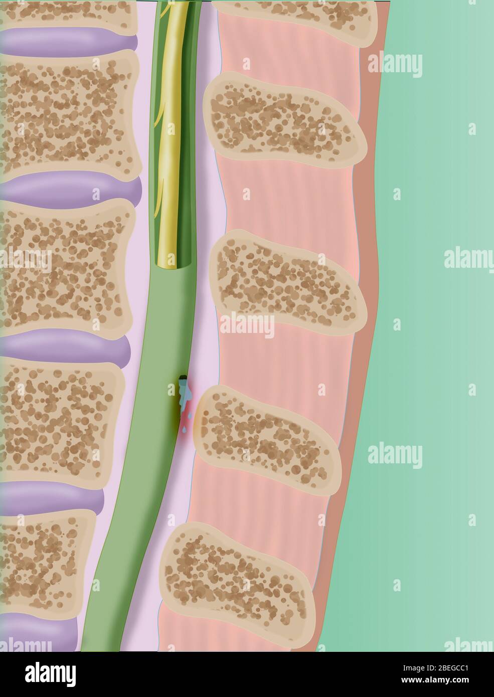 CSF Leak in the Spinal Cord, Illustration Stock Photo